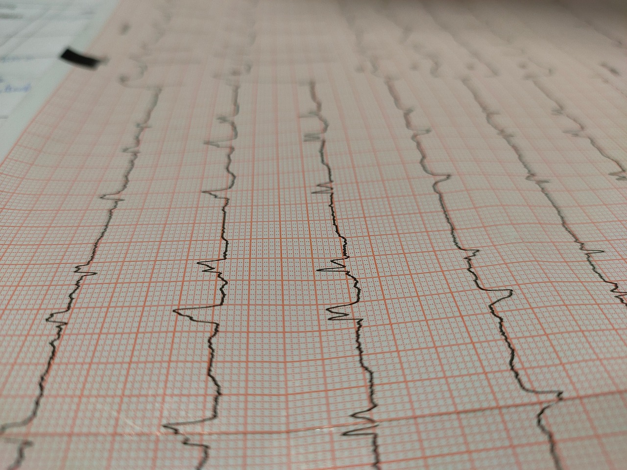 electrocardiogram, heart attack, tracing, cardiology, chest pain, heart attack, heart attack, heart attack, heart attack, heart attack, cardiology, chest pain