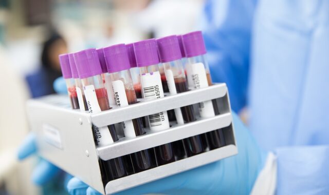 sample, lab, laboratory, scientist, medical, health, test, science, healthcare, research, tube, blue health, blue medical, blue science, blue research, blue lab, blue test, blue blood, blue laboratory, blue healthcare