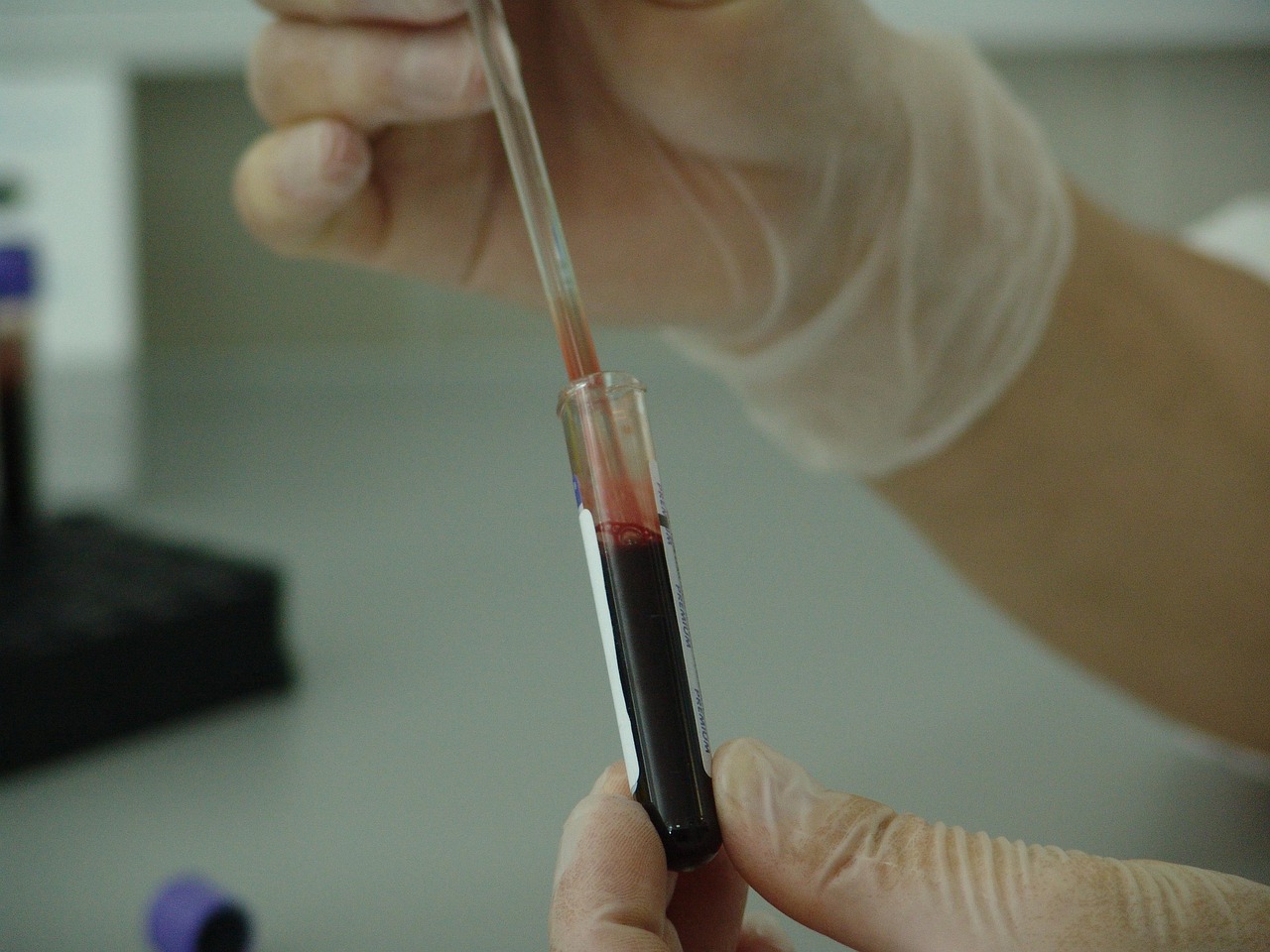 vial, analysis, laboratory, test, medical, medicine, science, lab, experiment, health, disease, tube, sample, hospital, scientific, biology, equipment, healthcare, doctor, research, liquid, virus, scientist, illness, cell, biochemistry, pharmaceutical, diagnosis, chemistry, microbiology, specimen, plasma, ampule, cells, biotechnology, immunology, dna, genetic, immune, cancer, aids, treatment, diagnose